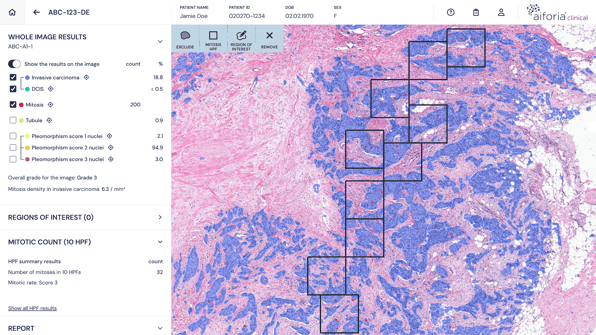 Breast-cancer-grading-UI