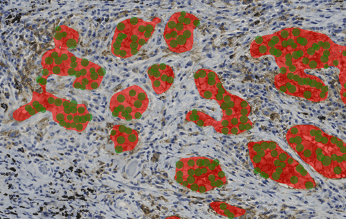 PD-L1 lung cancer after AI detection