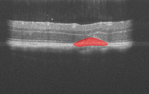 Ocular after AI detection