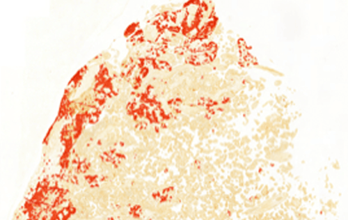 Preeclamtic detection in placental tissue