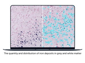 quantity and distribution of iron deposits in grey and white matter