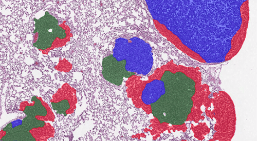 NSCLC tumor grading after AI detection