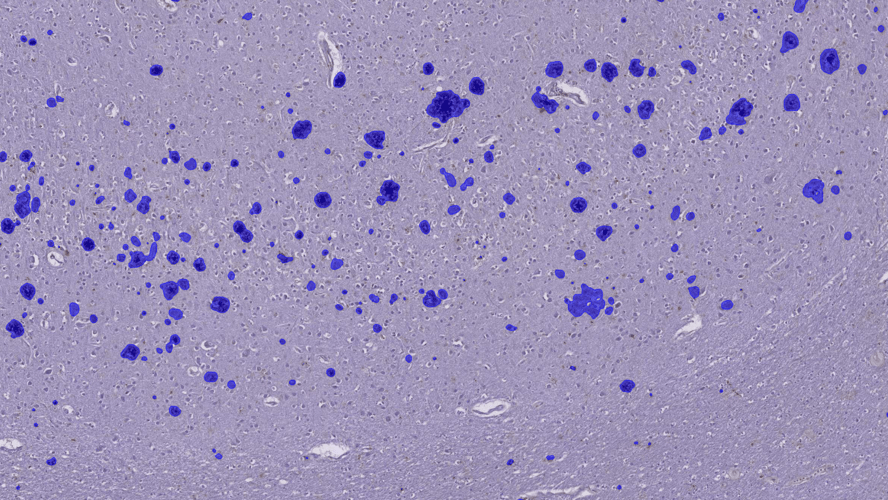 Massachusetts General Hospital case study: AI-assisted image analysis of neurodegenerative disease markers