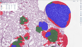automated lung cancer tumor grading