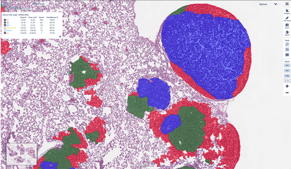 MIT case study: advancing lung cancer research with AI