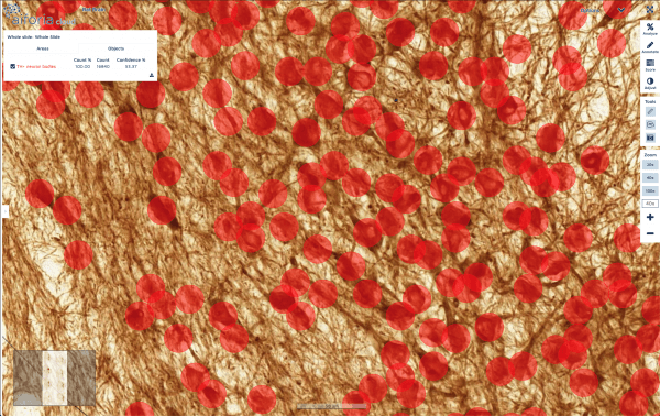Case study: AI-assisted neuron quantification for Parkinson's disease