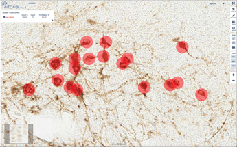 Parkinson’s disease analysis results