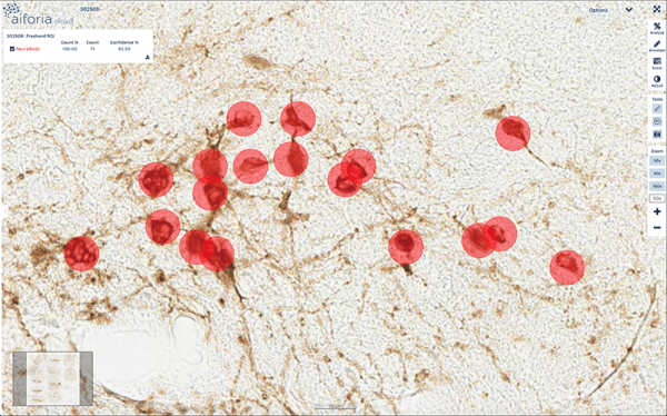 Sanofi case study: Parkinson's disease research with AI