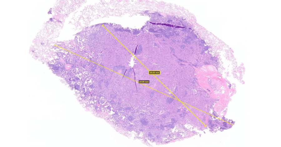 Case study: developing an AI model to determine invasion in pulmonary adenocarcinoma