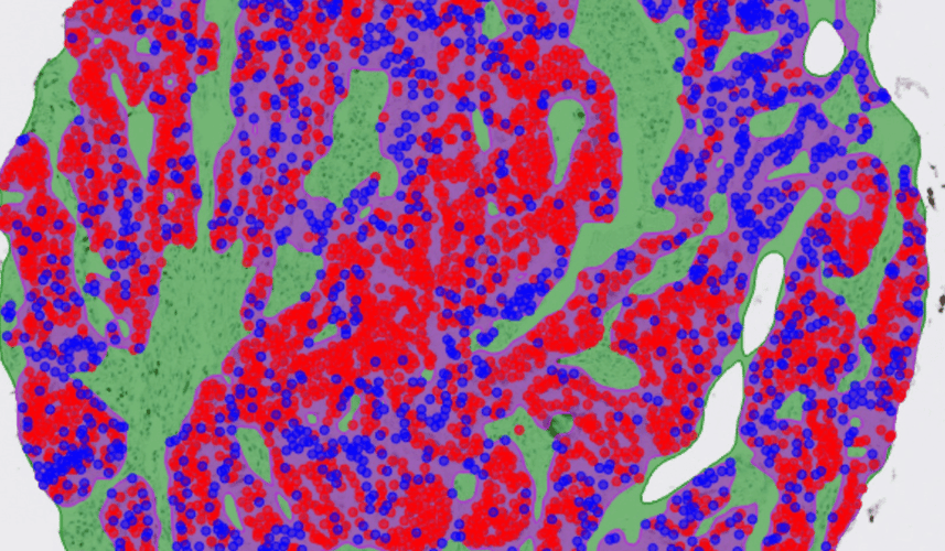 Cerba Research case study: utilizing AI in Ki-67 quantification in solid tumors