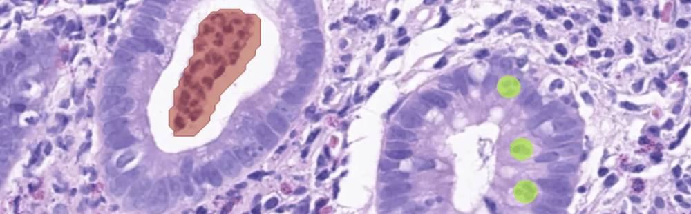 Colonoscopy_abscess and cryptitis_greenobjects-2
