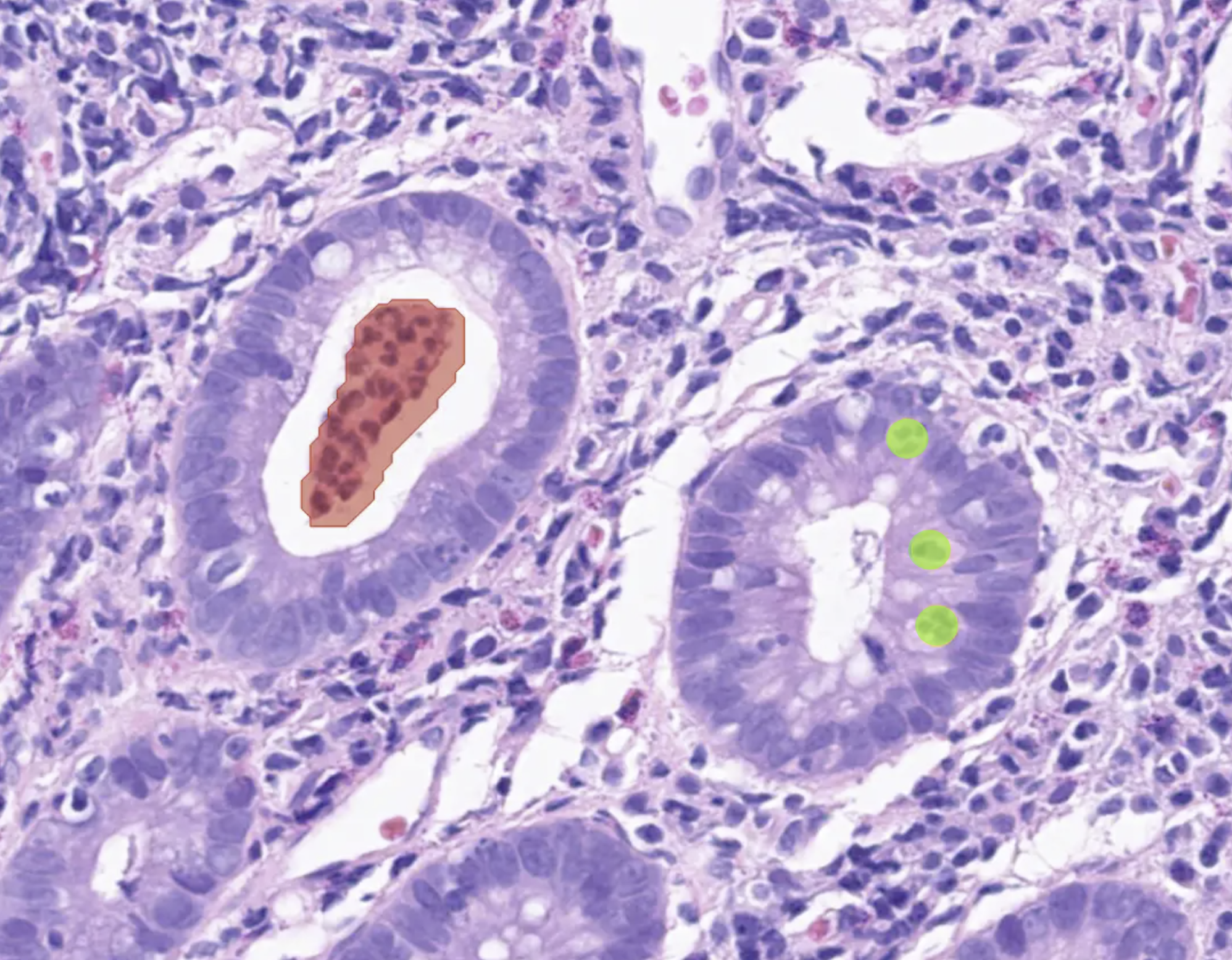 Colonoscopy_abscess and cryptitis_greenobjects