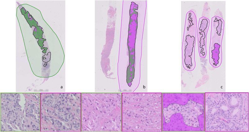 Example histology images of AI prediction in response to neoadjuvant chemotherapy.