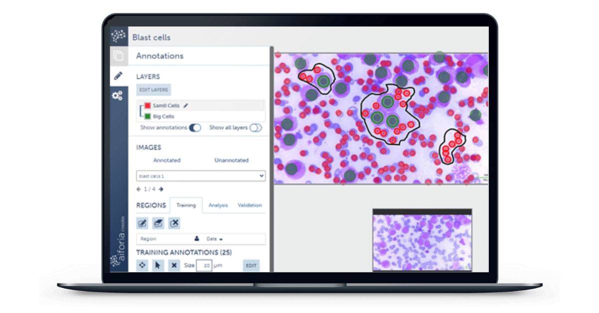 Fig. 2. The software was trained to become green after identifying blast cells and become red when identifying RBCs. When the slide was analyzed for results, it diagnosed almost all the blast cells except the ones on the bottom of the picture. The software was also able to tell the number of blast cells and RBCs in the picture (Blue arrow)