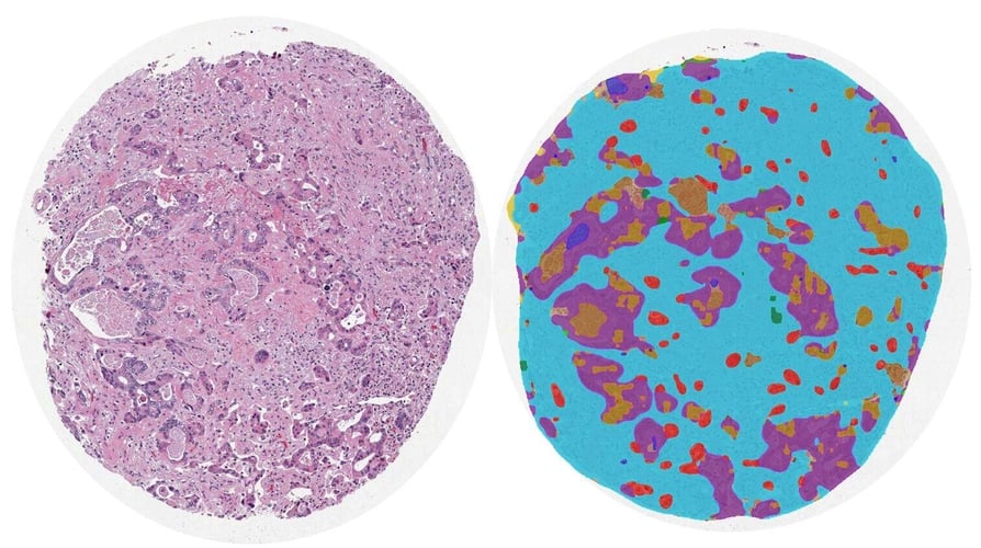 Leveraging AI-driven quantitative pathology to identity novel prognostic histologic signatures in colorectal carcinoma