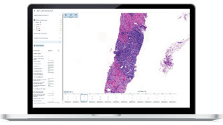 Clinical AI Model for Prostate Cancer - Gleason Grade Groups in laptop