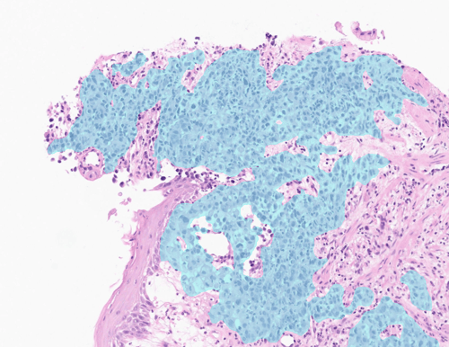 Transforming gastric cancer diagnostics with AI