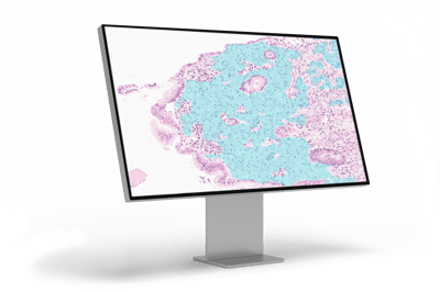 Gastric cancer_monitor left angle_1.1