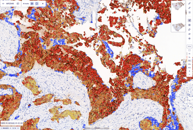 Unlocking diagnostic value at Fimlab with Aiforia® Breast Cancer Suite