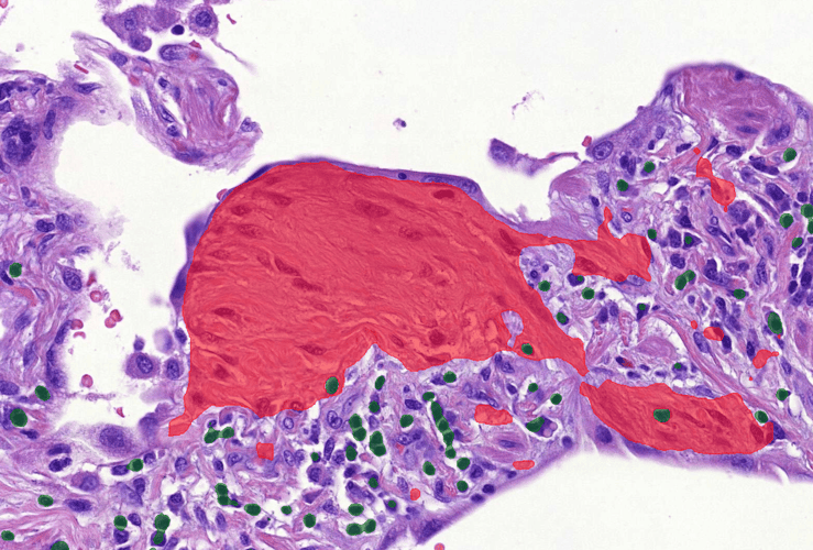 Case study: quantitating histopathological features of idiopathic pulmonary fibrosis