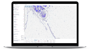 Ki67 hotspot 1 clinical_laptop