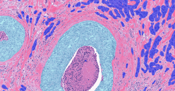 Aiforia® Breast Cancer Grading