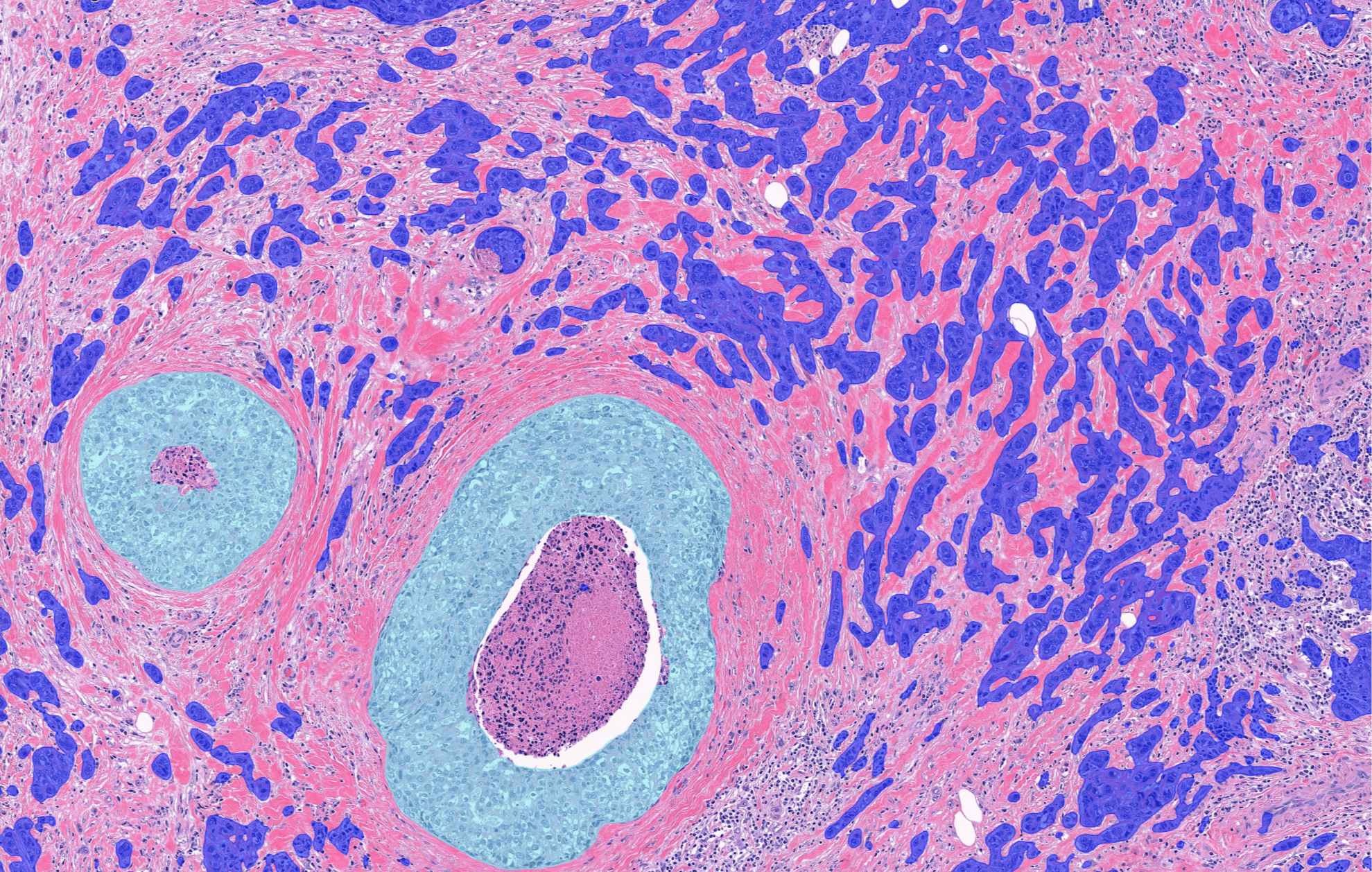 breast-cancer-grading_image 1