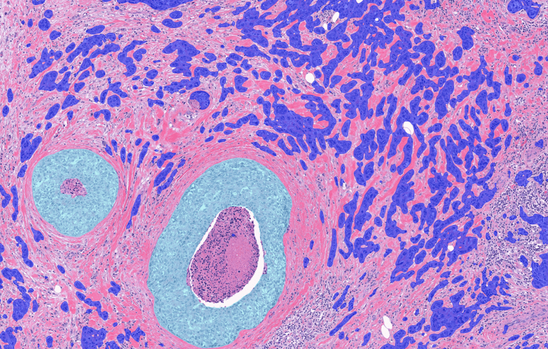 Harmony on the horizon – could AI standardize breast cancer grading?