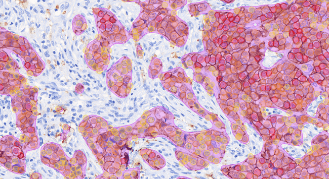 Aiforia® Breast Cancer HER2