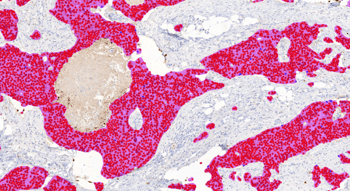 Aiforia® Breast Cancer ER