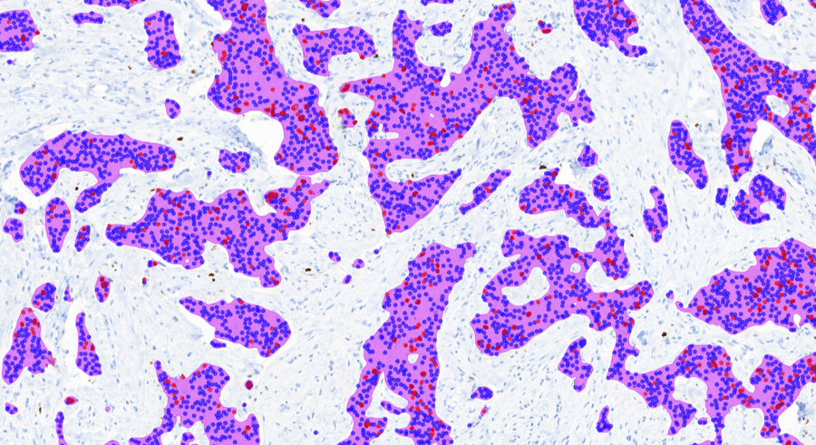 Cerba Research case study: utility of AI in Ki-67 scoring of breast cancer
