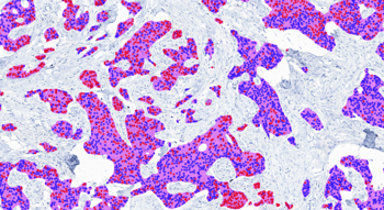 Aiforia® Breast Cancer PR