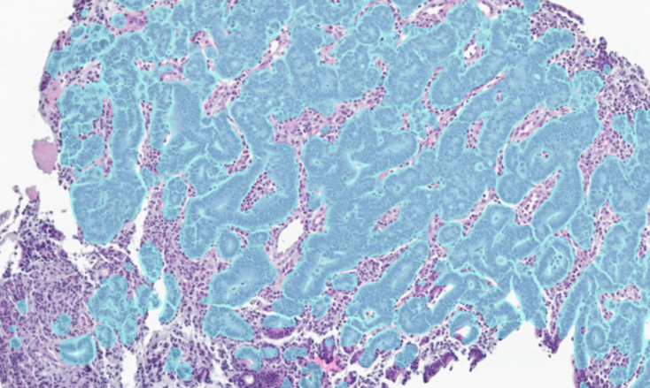 Gastric cancer model-1