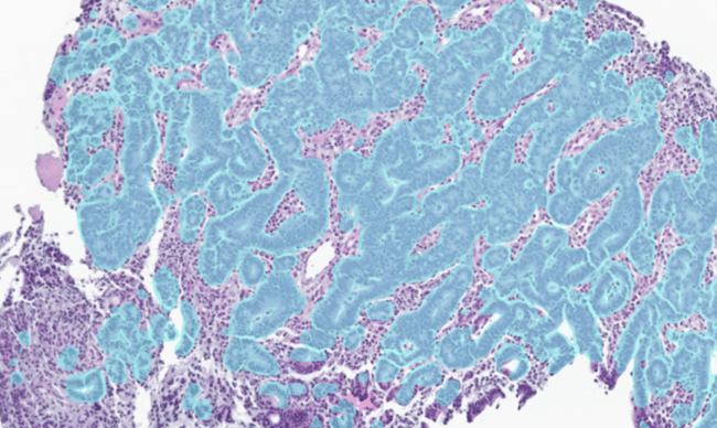 Aiforia® Gastric Cancer