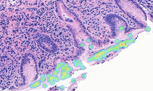 Helicobacter pylori (H. pylori)