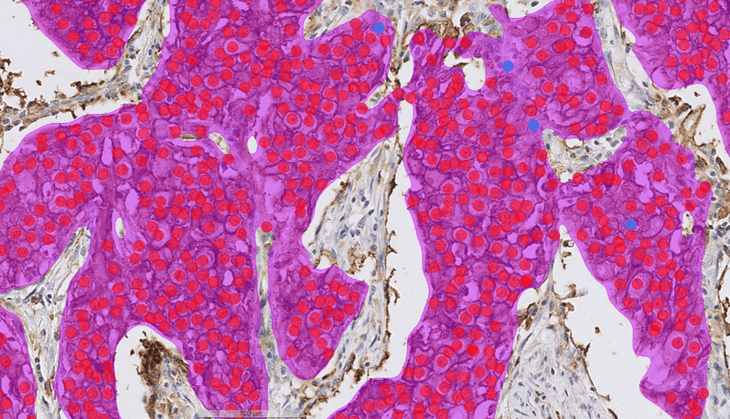 Lung_PDL1_20x_2_AImasks-1