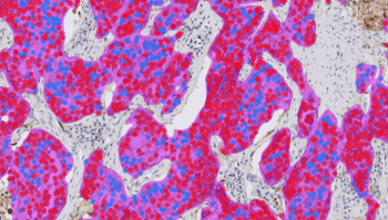 Aiforia® Lung Cancer PD-L1