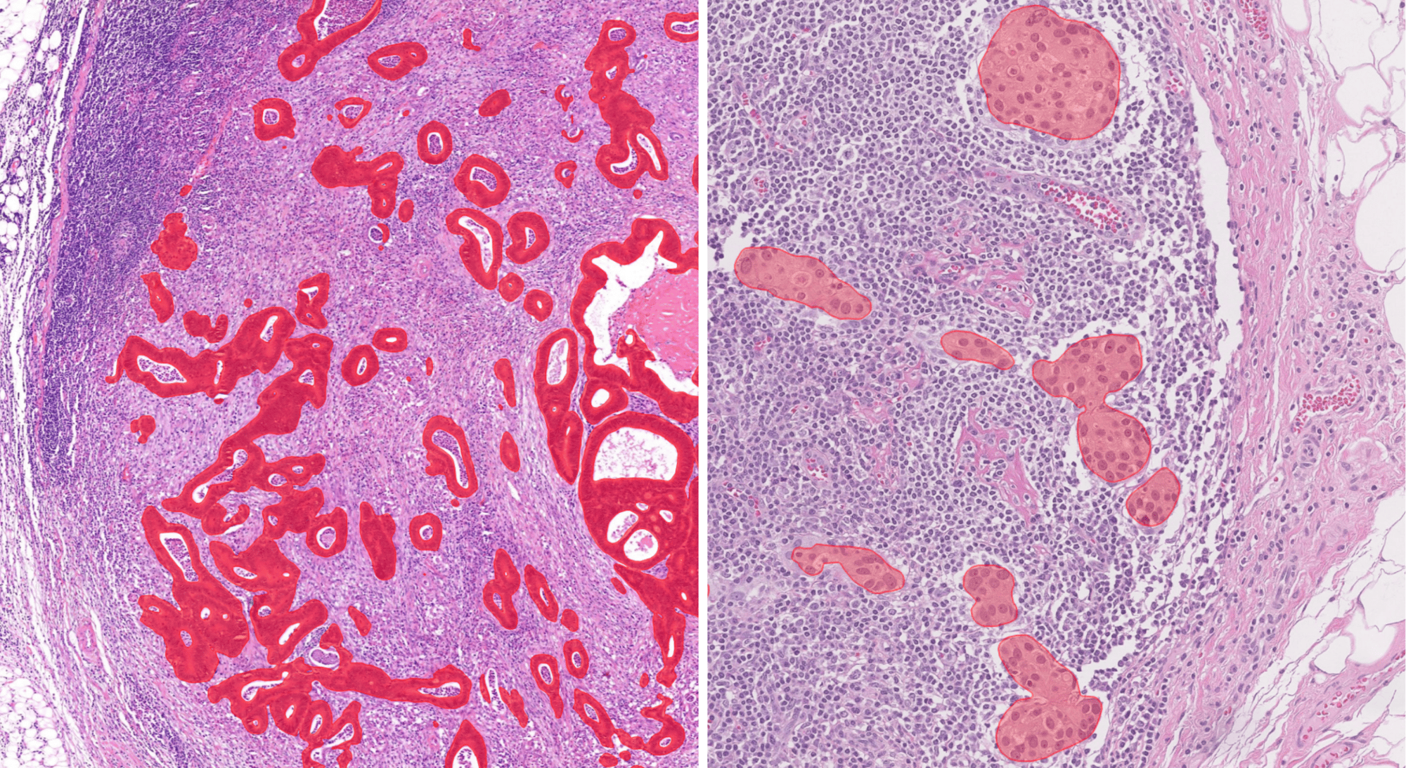 Lymph Node Metastasis _Breast and Colon