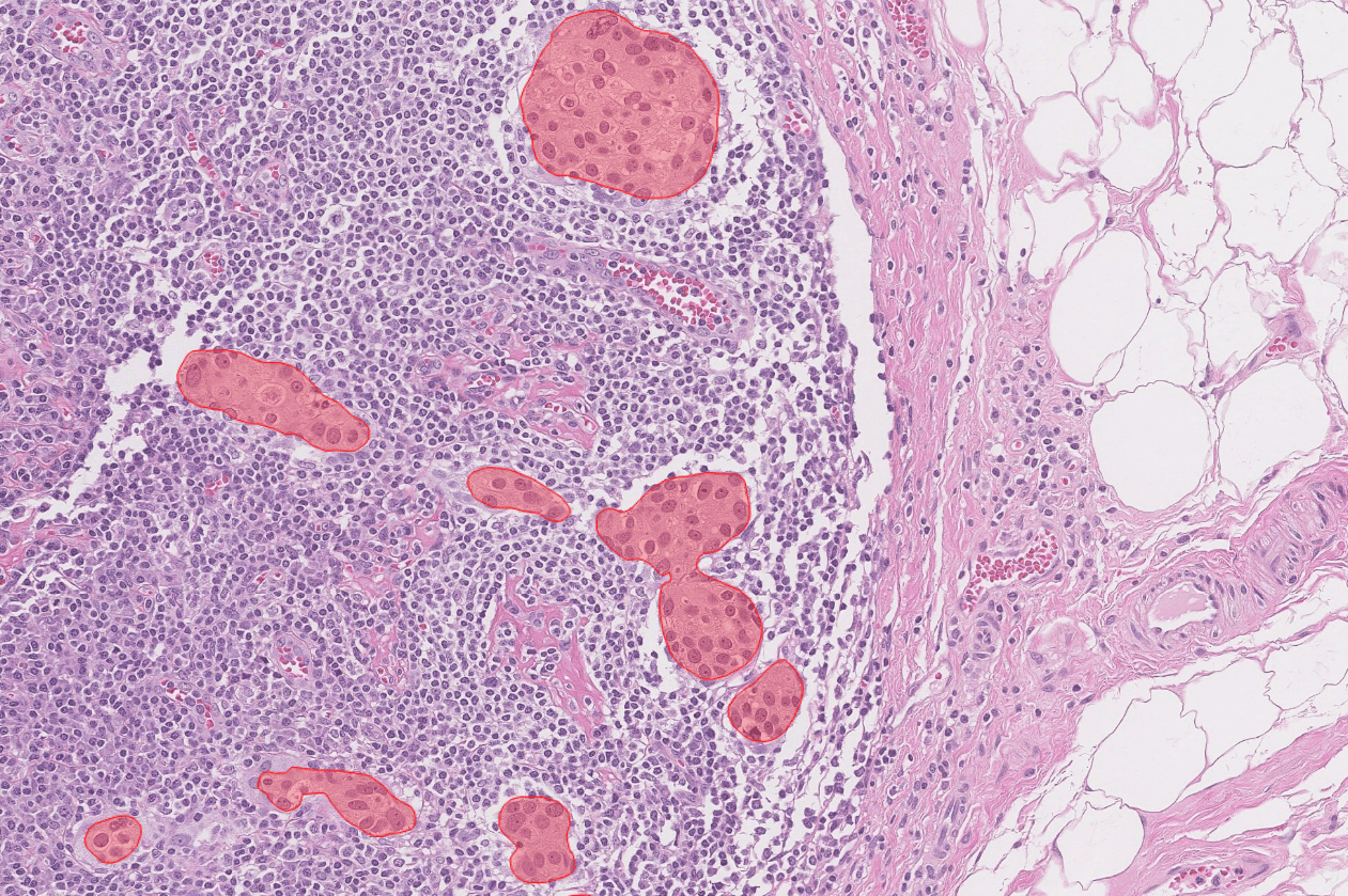 aiforia-lymph-node-metastasis-breast