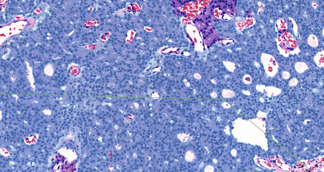 Aiforia® Prostate Cancer G4 Cribriform