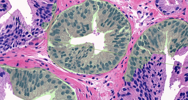 Aiforia® Prostate Cancer HG-PIN