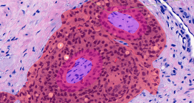 Aiforia® Prostate Cancer PNI