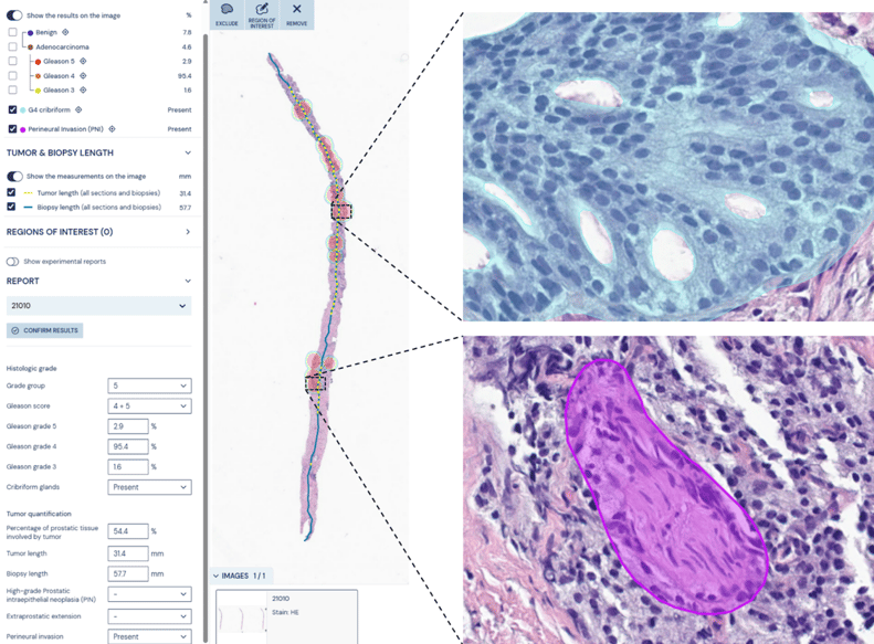 Aiforia Prostate Cancer Suite_key features image-1