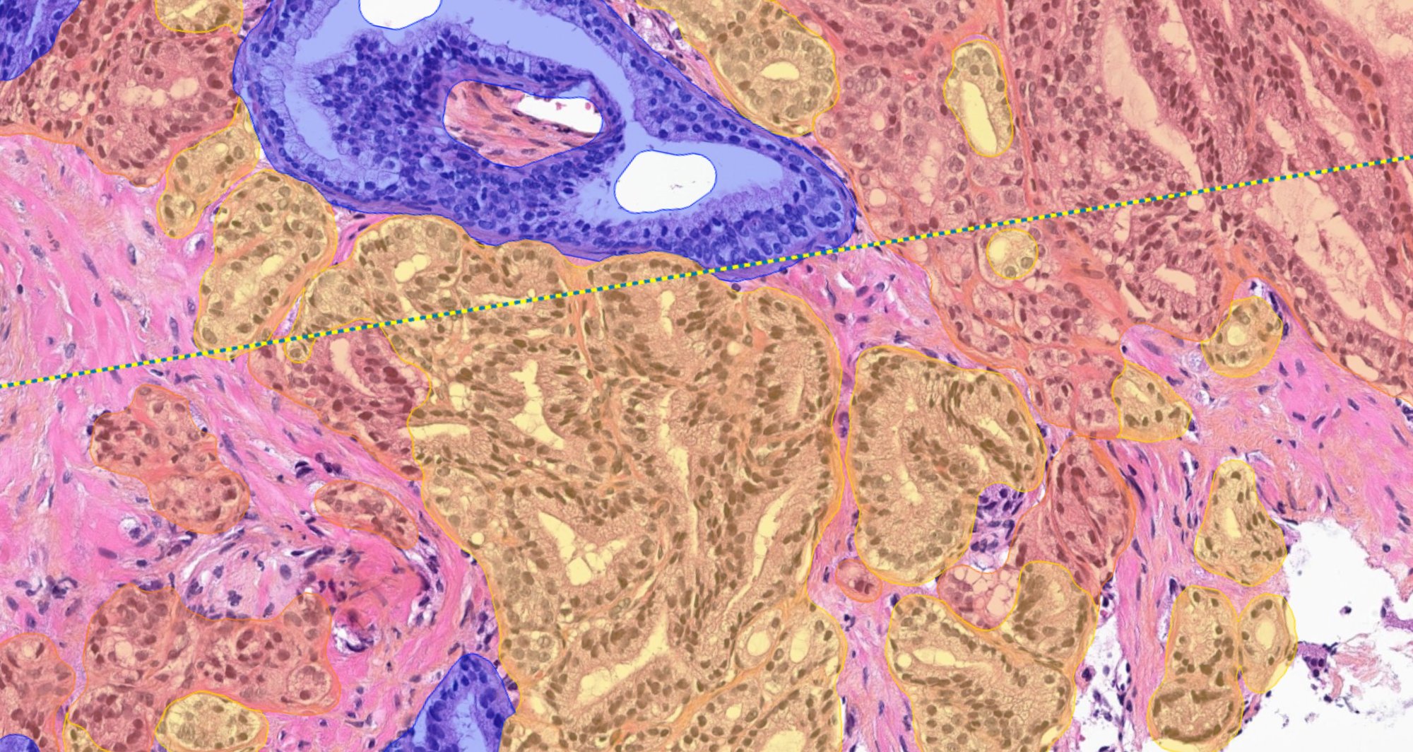 Prostate Cancer Biopsy 1