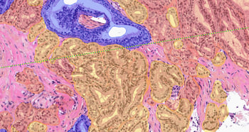 Aiforia® Prostate Cancer Biopsy