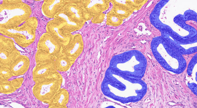 Aiforia® Prostate Cancer Gleason Grade Groups