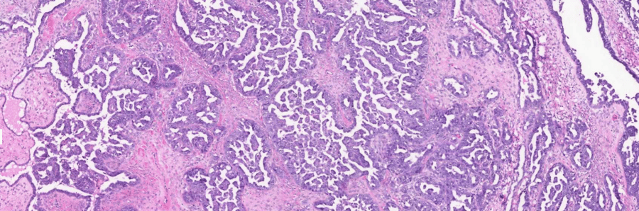 Can AI predict patient outcomes in ovarian cancer?