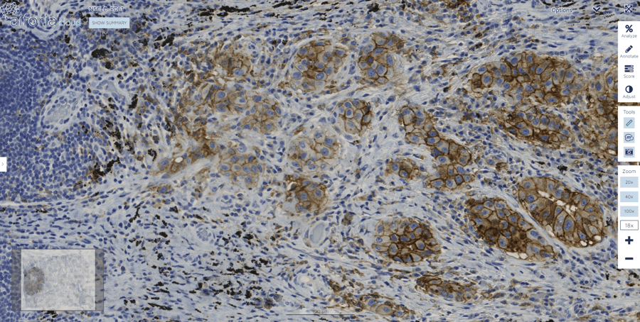 Case study: automating the quantification of PD-L1 in lung cancer