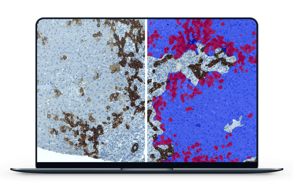 primary sclerosing cholangitis AI analysis