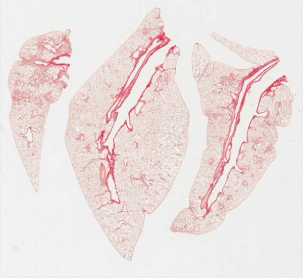 Automated image analysis of lung fibrosis